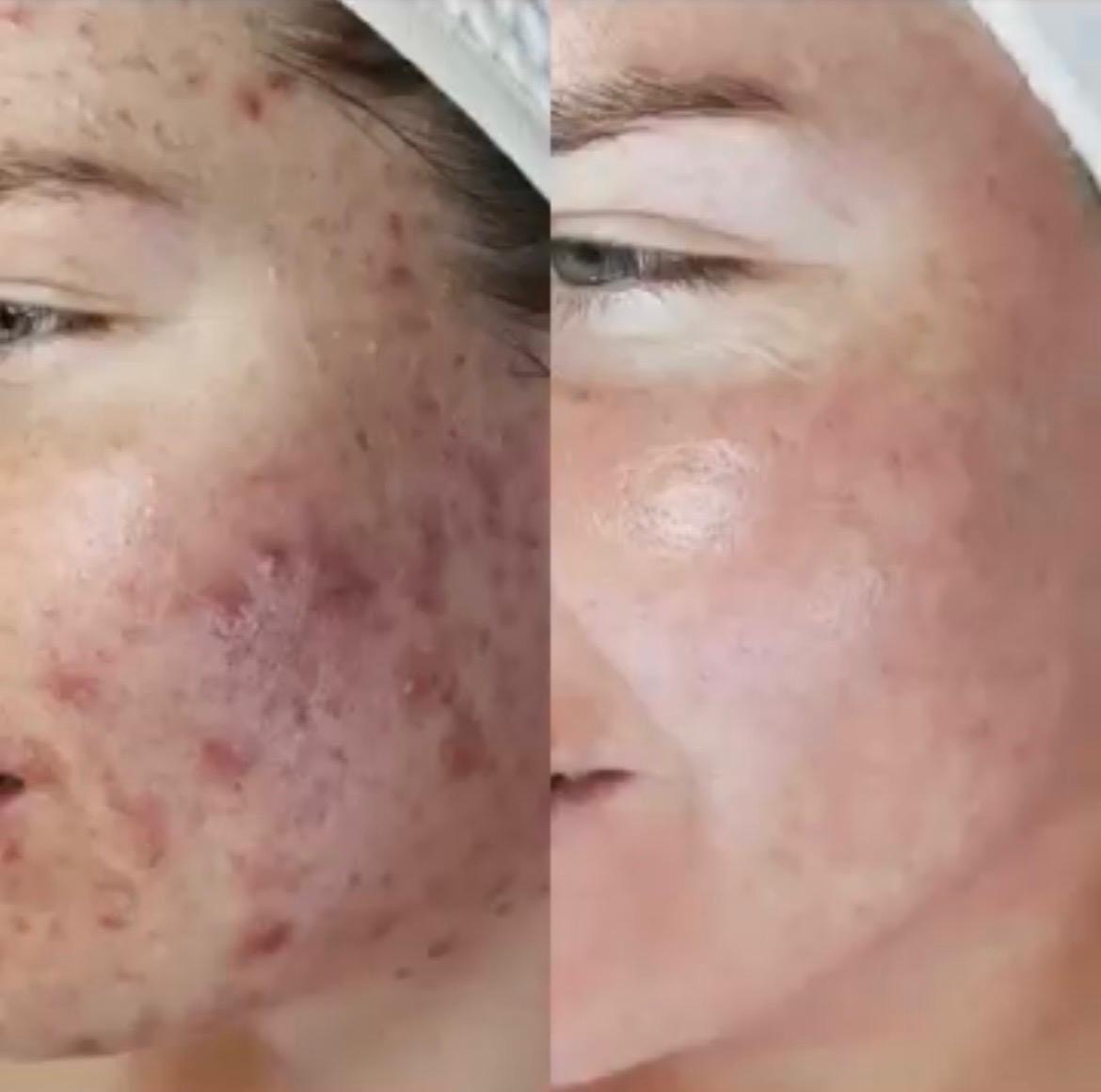 Before and after Dermalux LED phototherapy for active acne, showing clearer, calmer skin