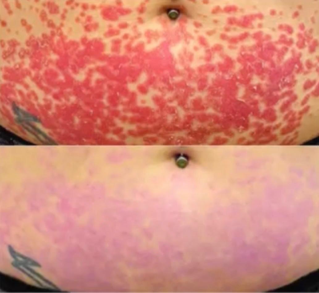 Before and after Dermalux LED phototherapy on body psoriasis, showing significantly reduced plaques and redness