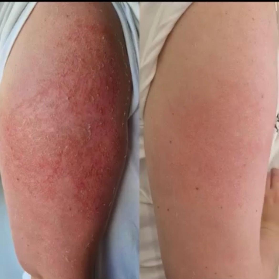 Before and after Dermalux LED phototherapy showing reduced redness and calmed skin