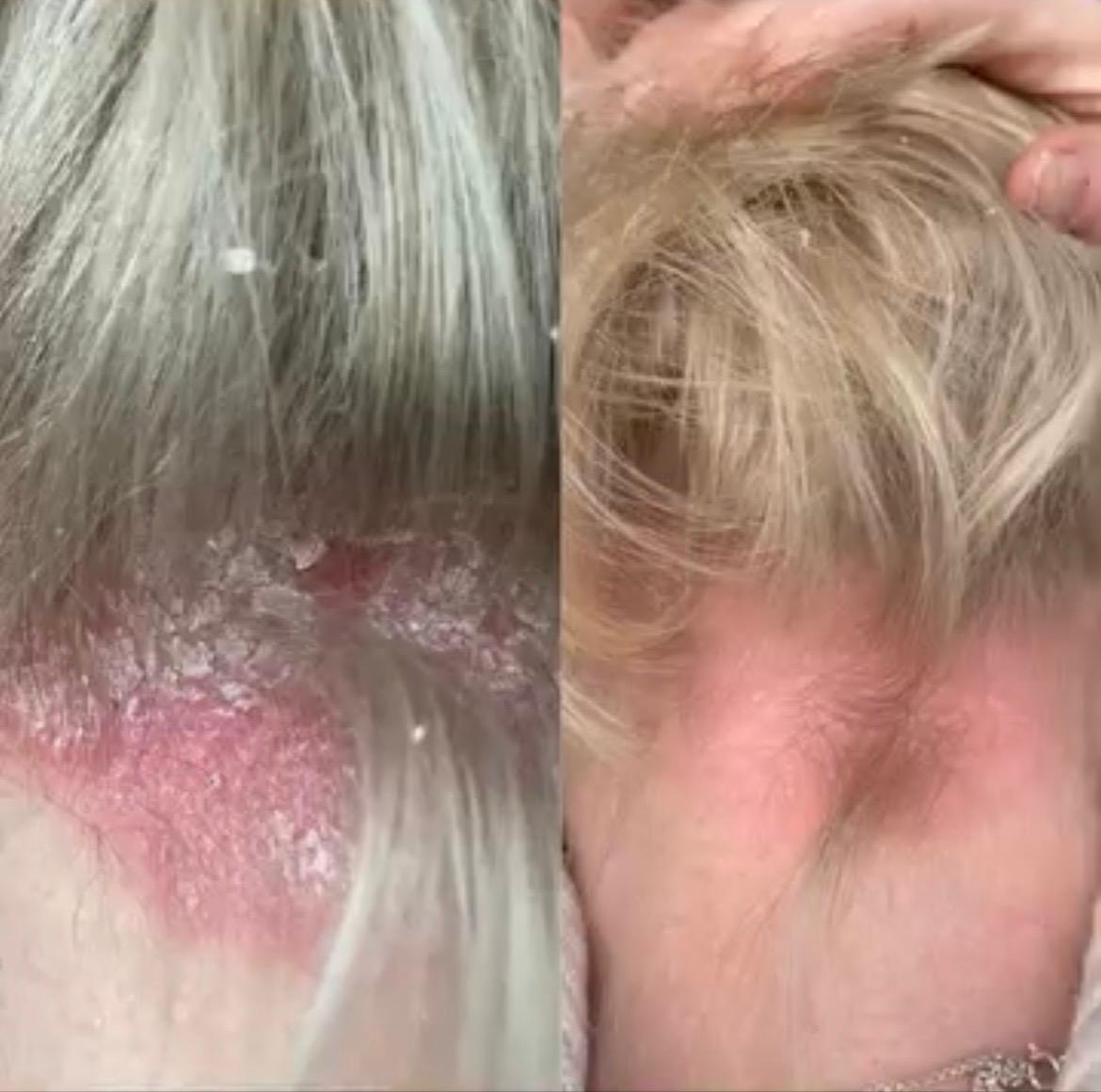 Before and after Dermalux LED phototherapy on scalp psoriasis, showing reduced scaling and redness